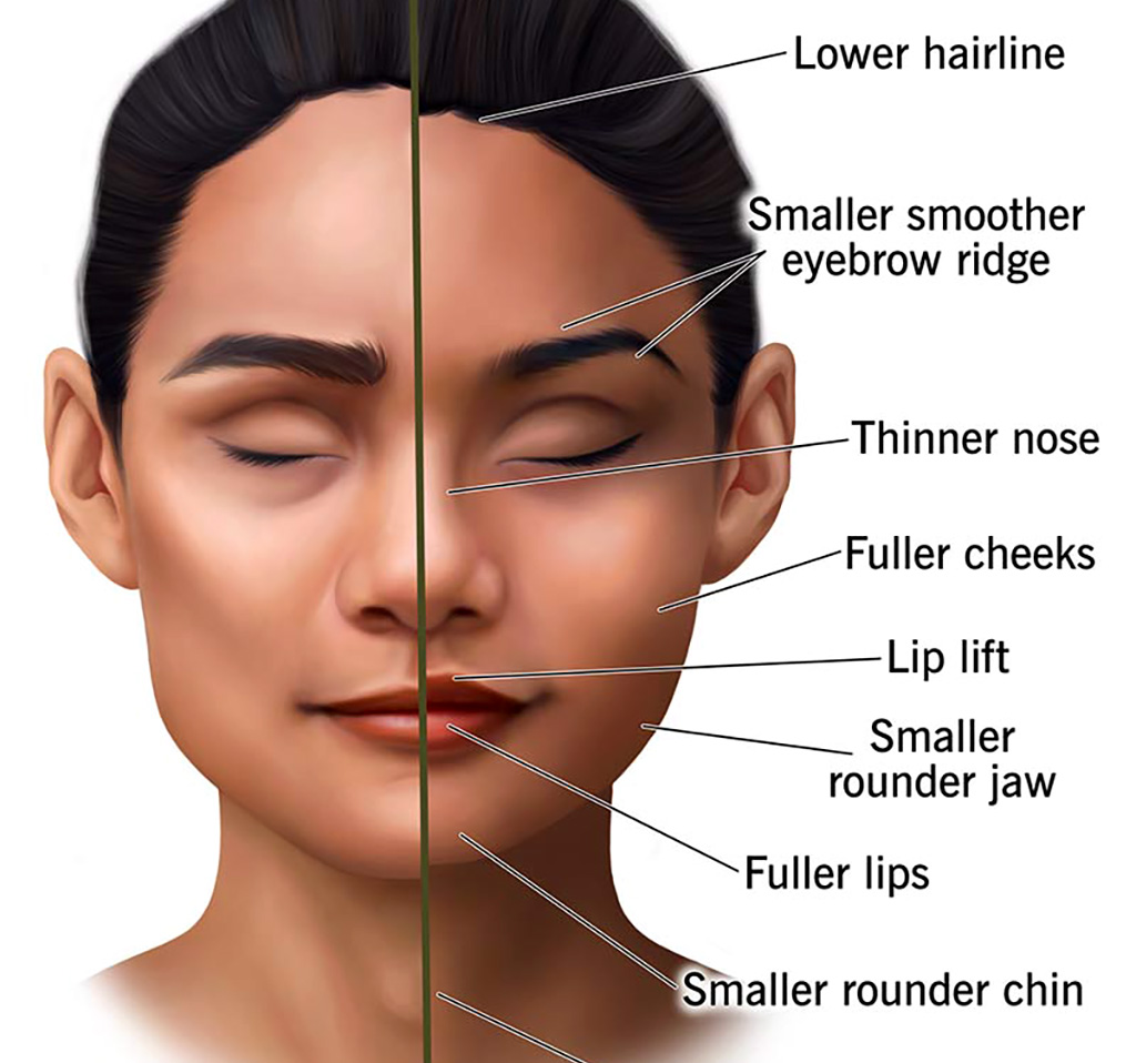 Facial feminization surgery diagram cropped from a 2023 Cleveland Clinic image. It shows the several different procedures on an illustration of a face split vertically into before and after halves.
